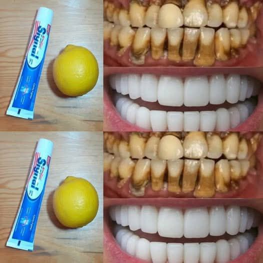 Natural Teeth Whitening at Home in One Day