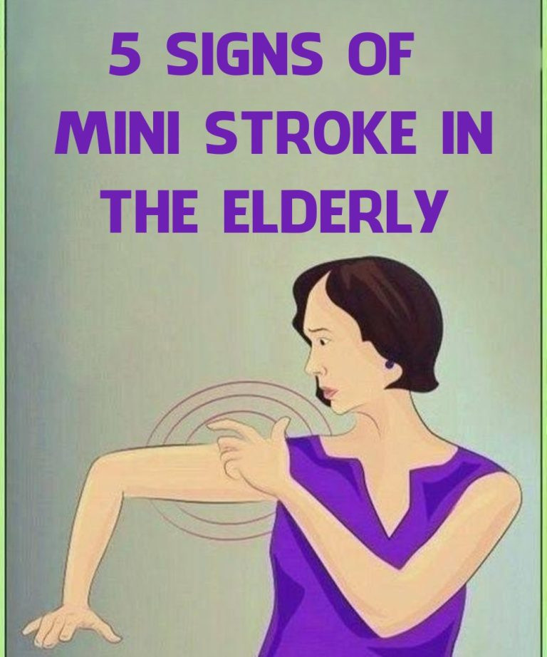 Mini Stroke in the Elderly: Recognizing Common and Unusual Symptoms