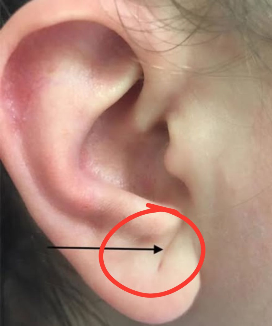 If this sign appears in your ear, it is a war:ning sign that you have ca…