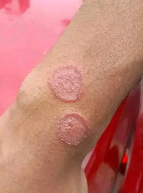 Mysterious Round Marks on the Skin — What Do They Really Mean?