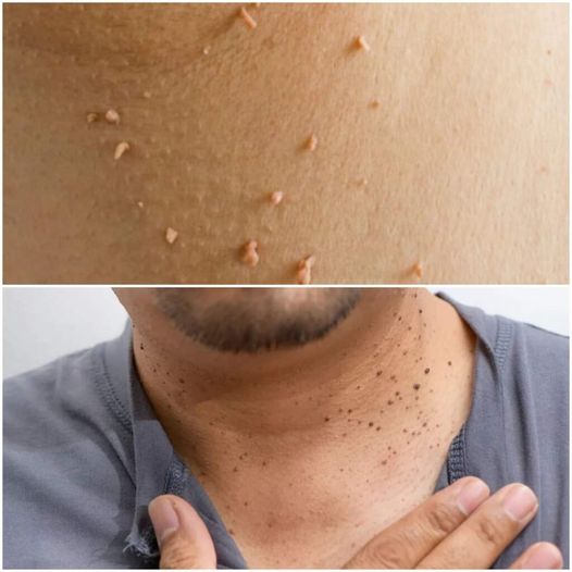 Simple Home Remedies for Skin Tags and Warts