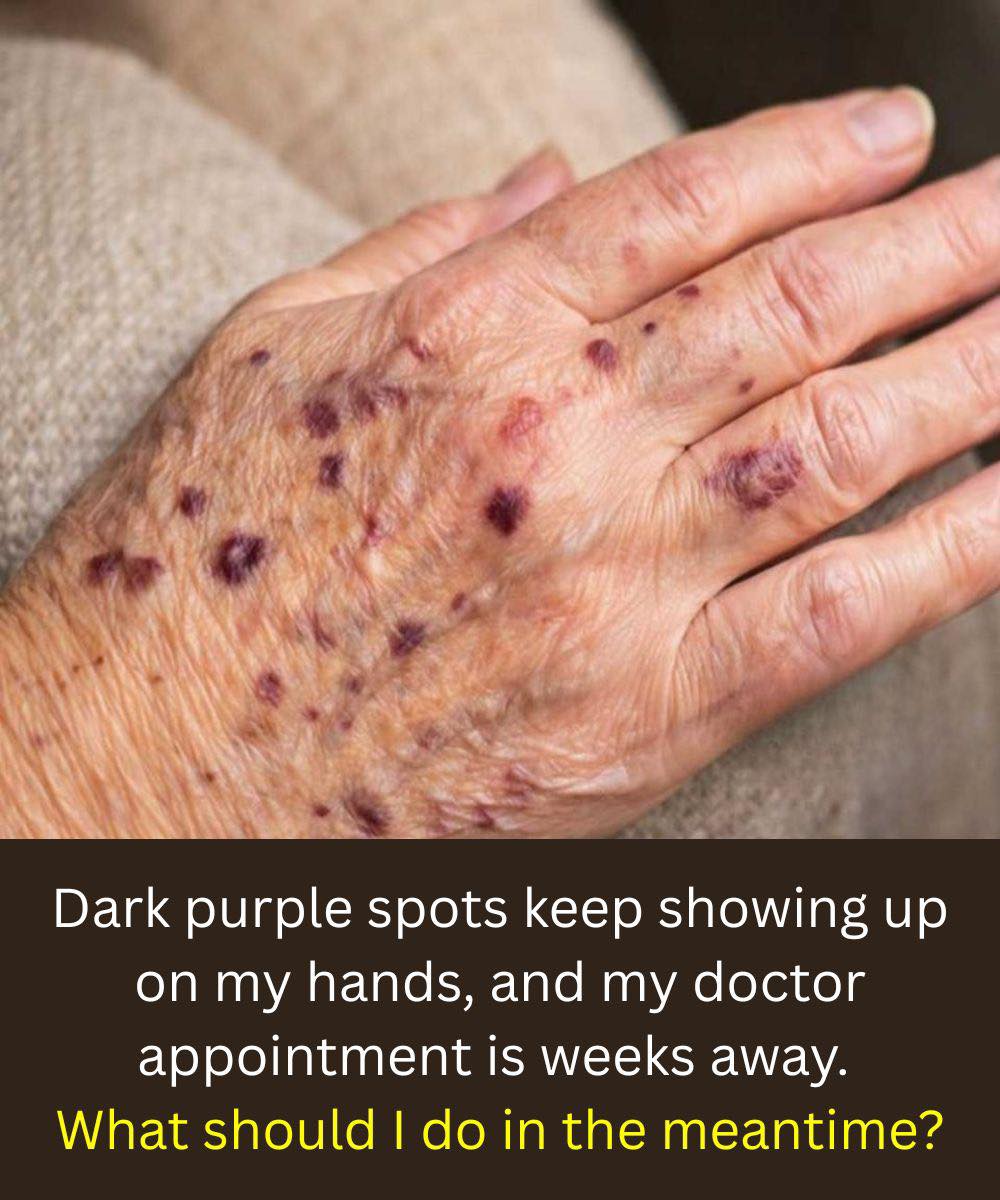 Visible Veins What They Mean and Dark purple spots keep showing up on my hands, and my doctor appointment is weeks away. What should I do in the meantime?You Might See Them