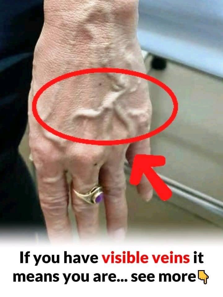 When to Worry About Veins That Appear Out of Nowhere
