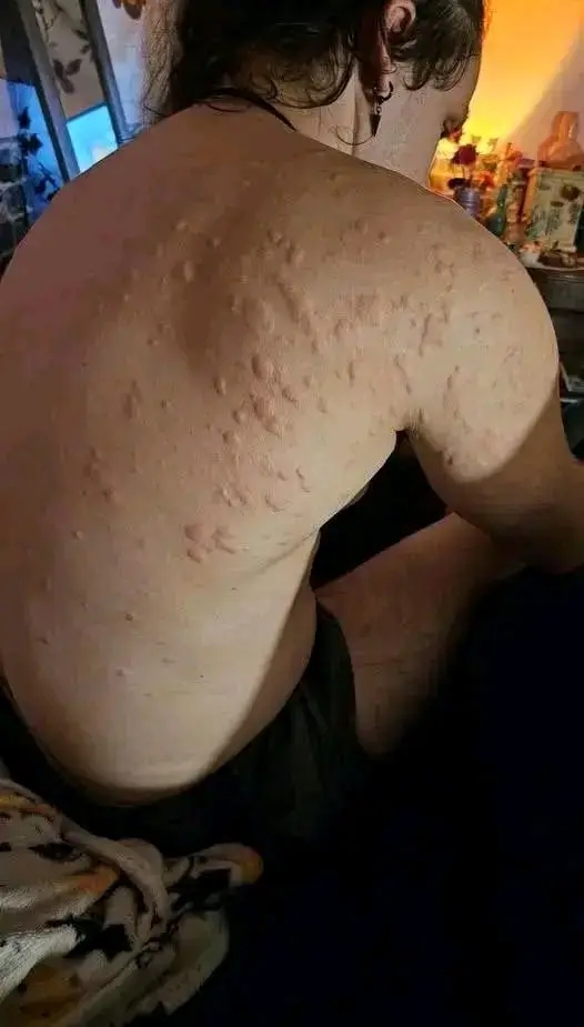 Painful Pink Bumps in a Line on the Skin? This Rare Condition Could Be the Reason