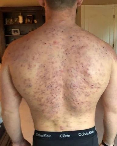 20 Skin Problems for Men: Ugly Side of Masculinity No One Talks About.