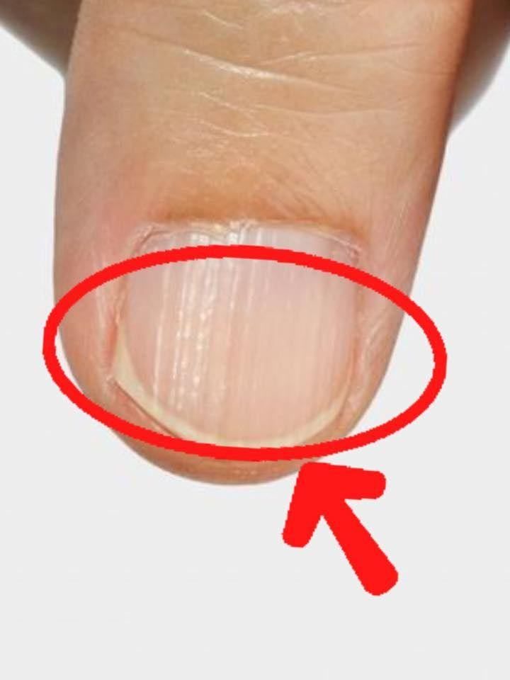 If such lines appear on your nails after the age of 40, it’s a clear sign that…