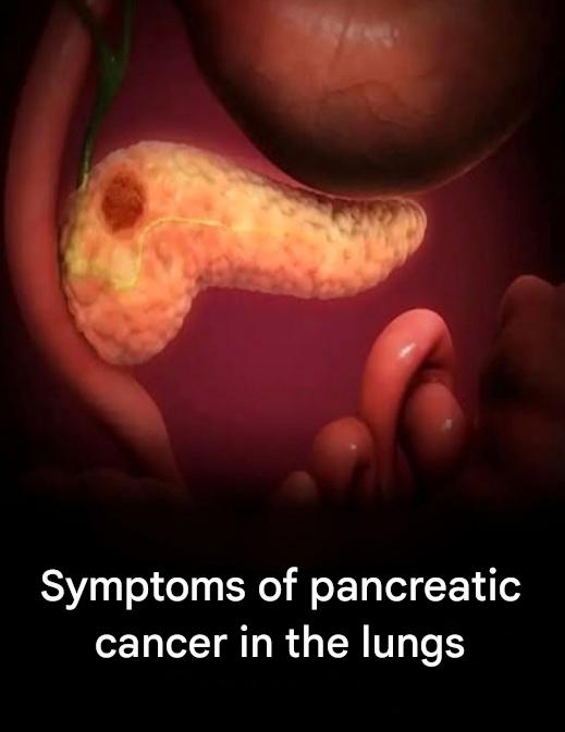 Unusual signs of colon cancer that women ignore for years