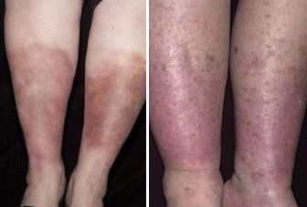 Venous Insufficiency | Venous Stasis | Venus Swelling