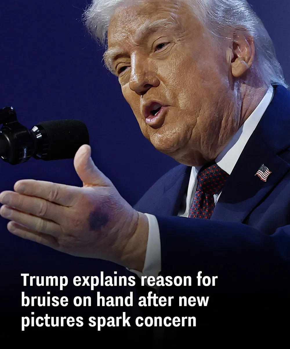 Trump explains reason for bruise on hand after new pictures spark concern